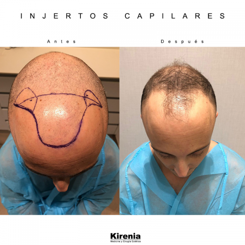 Microinjertos Capilares